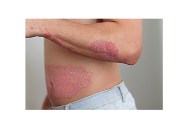 How do I get rid of Psoriasis on my elbows, knees and scalp? Nutritional Strategies to Improve Skin Health and Overall Health Too.