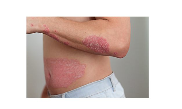 How do I get rid of Psoriasis on my elbows, knees and scalp? Nutritional Strategies to Improve Skin Health and Overall Health Too.