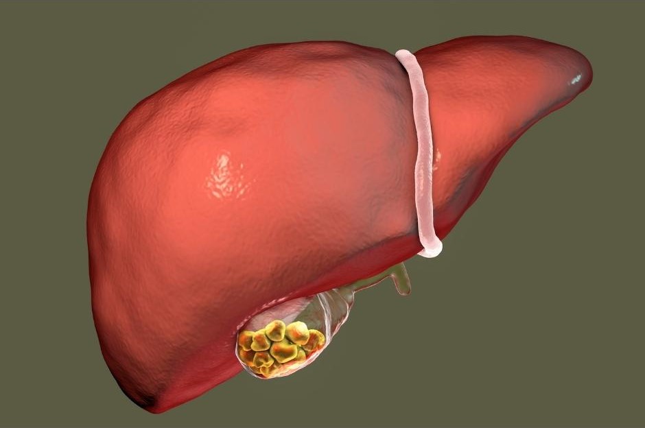 Liver and Gall Bladder with stones